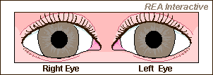 APD Left Eye