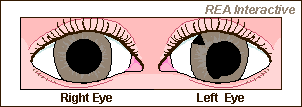 Reverse APD Right Eye